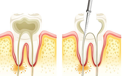 Root Canal Procedure Diagram