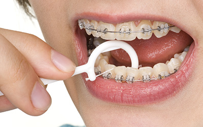 Cloe-up of mouth flossing with braces