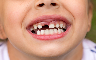Little girl with missing tooth