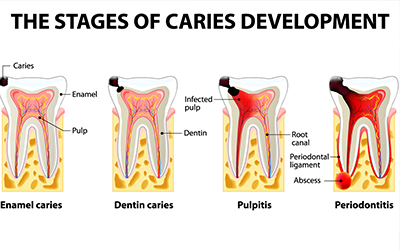 Stages of gum disease