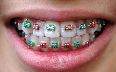 Mouth with braces