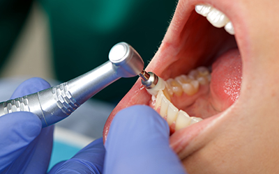 A person getting there teeth cleaned by the dentist