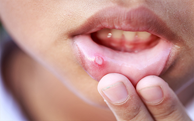 A young child with canker sores on his lip